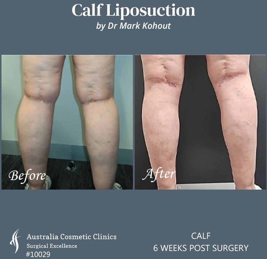 Calf Liposuction Patient 10029 BACK