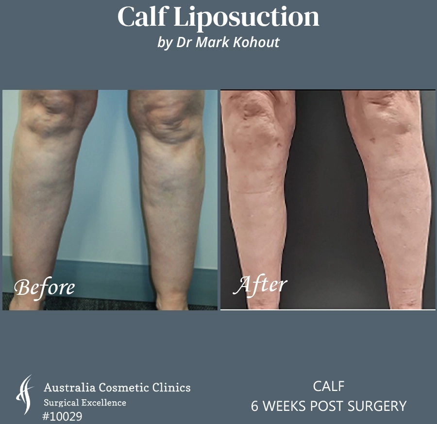 Calf Liposuction Patient 10029 FRONT